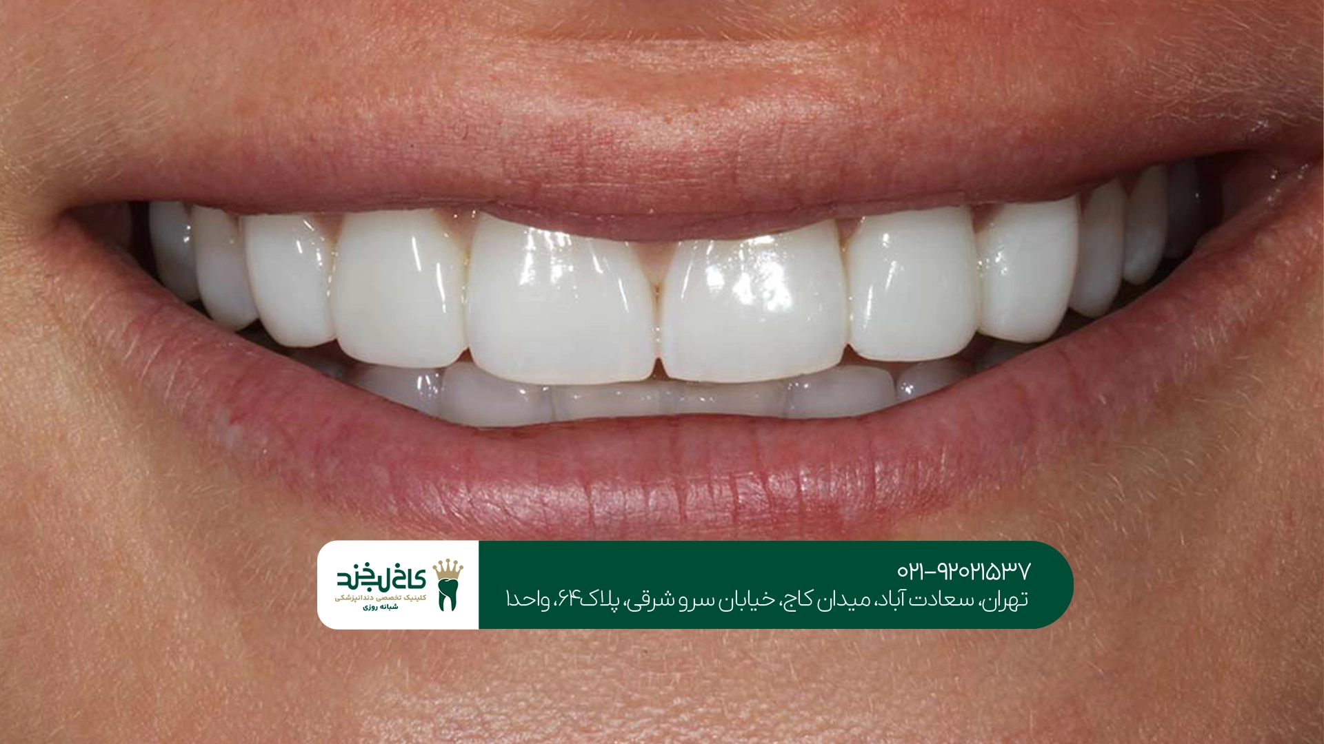 بهترین روش زیبایی دندان برای بزرگسالان