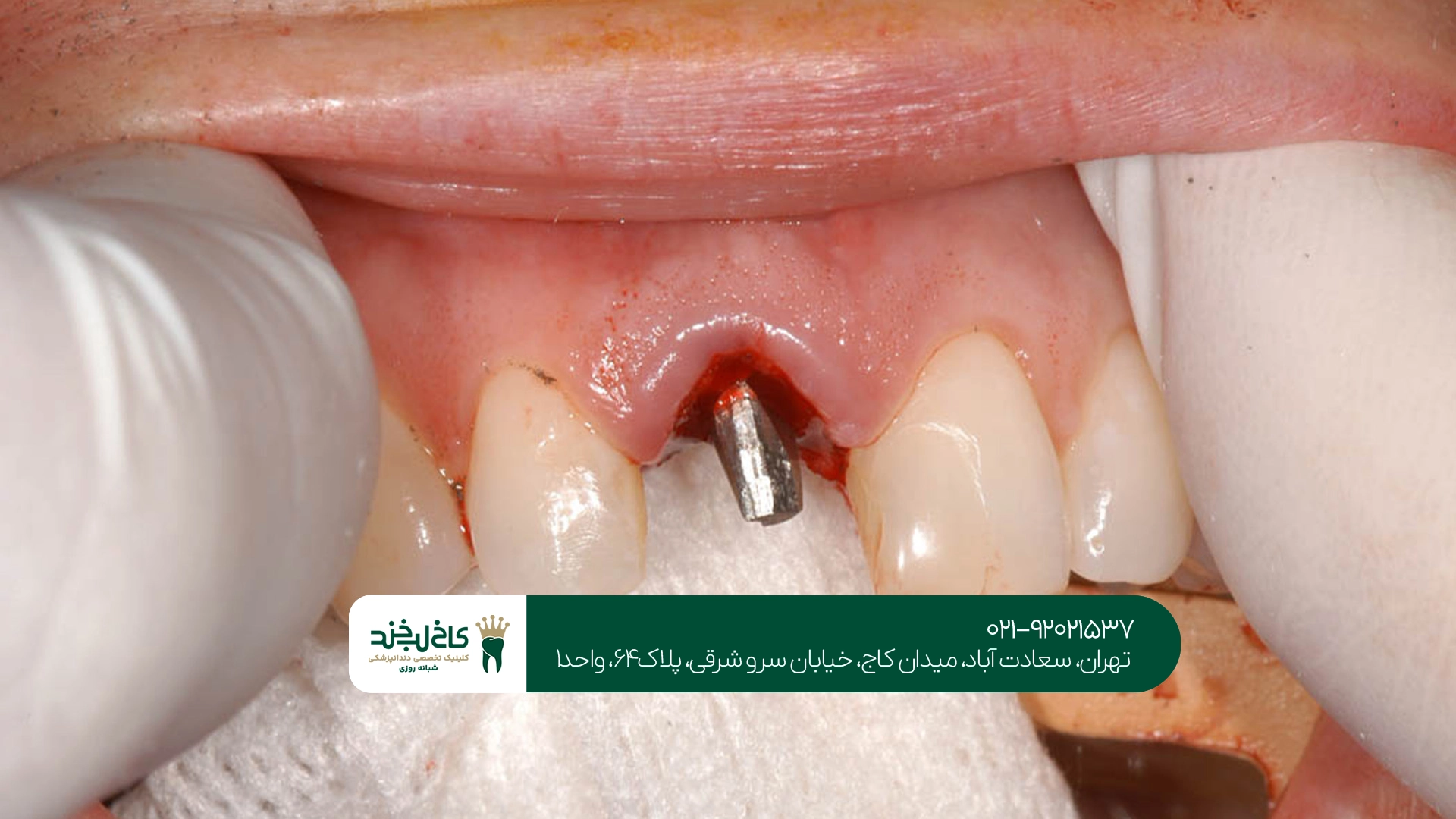 ویژگیهای بهترین متخصص ایمپلنت برای درمانهای پیچیده
