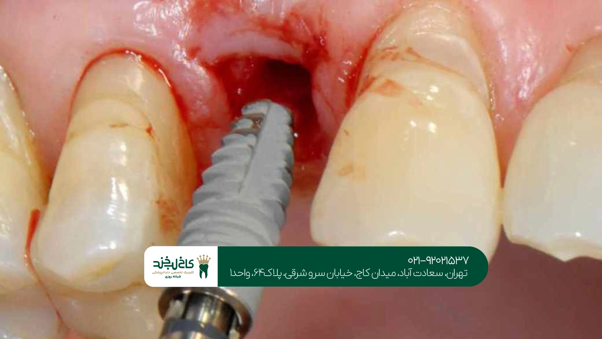 ویژگیهای یک مرکز ایمپلنت خوب در تهران