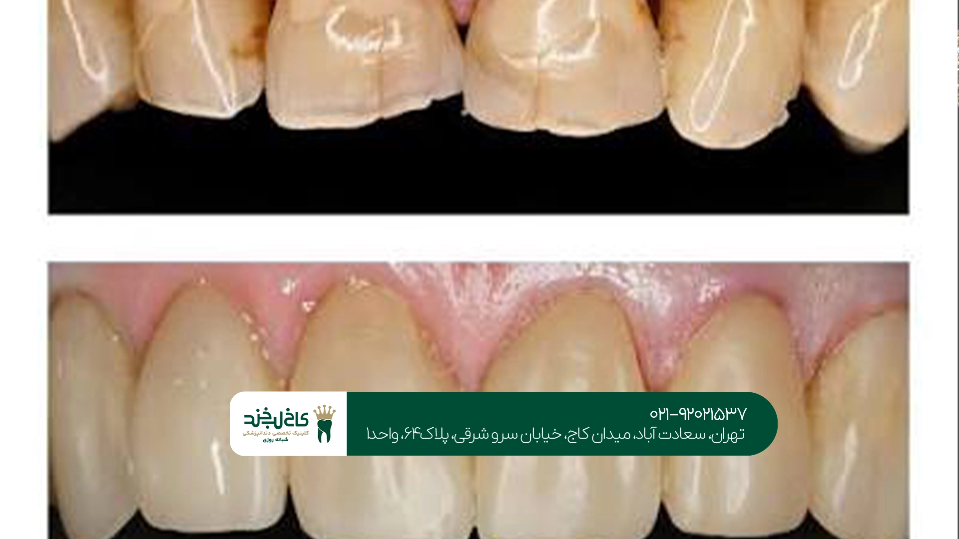 تاج دندان بعد از عصبکشی