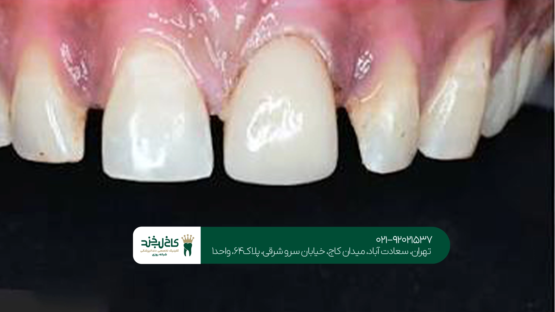 تاج دندان برای دندان جلو