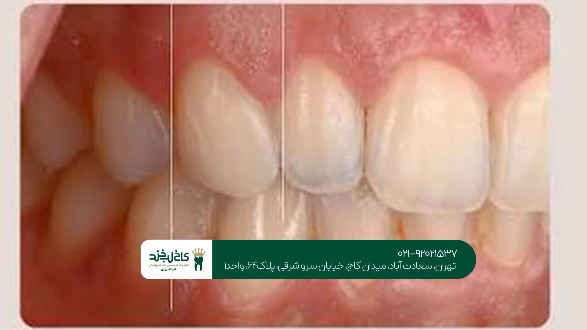 قیمت تاج دندان به چه عواملی بستگی دارد؟
