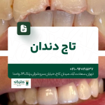 تاج دندان