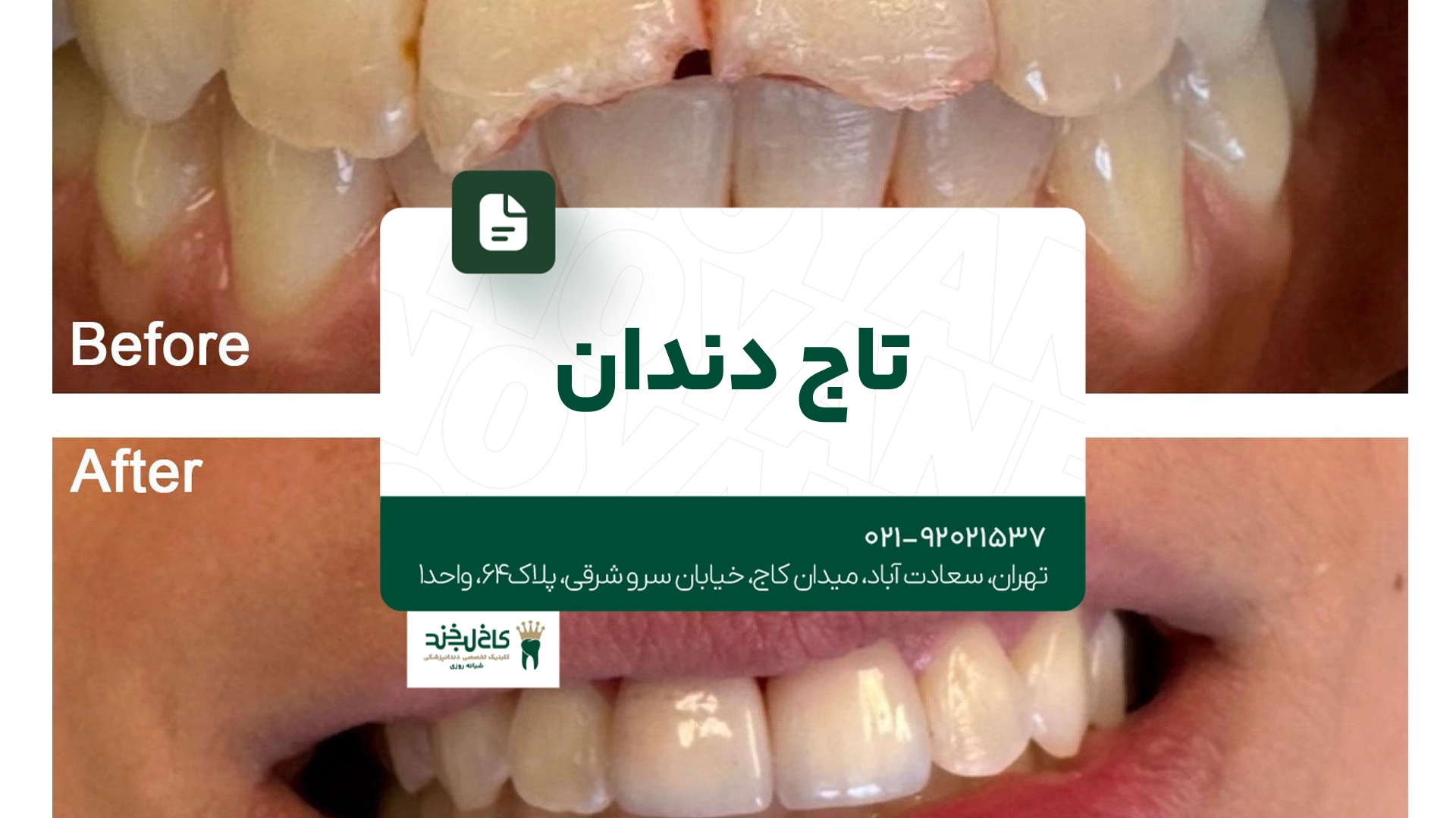 تاج دندان