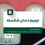 ترمیم دندان شکسته