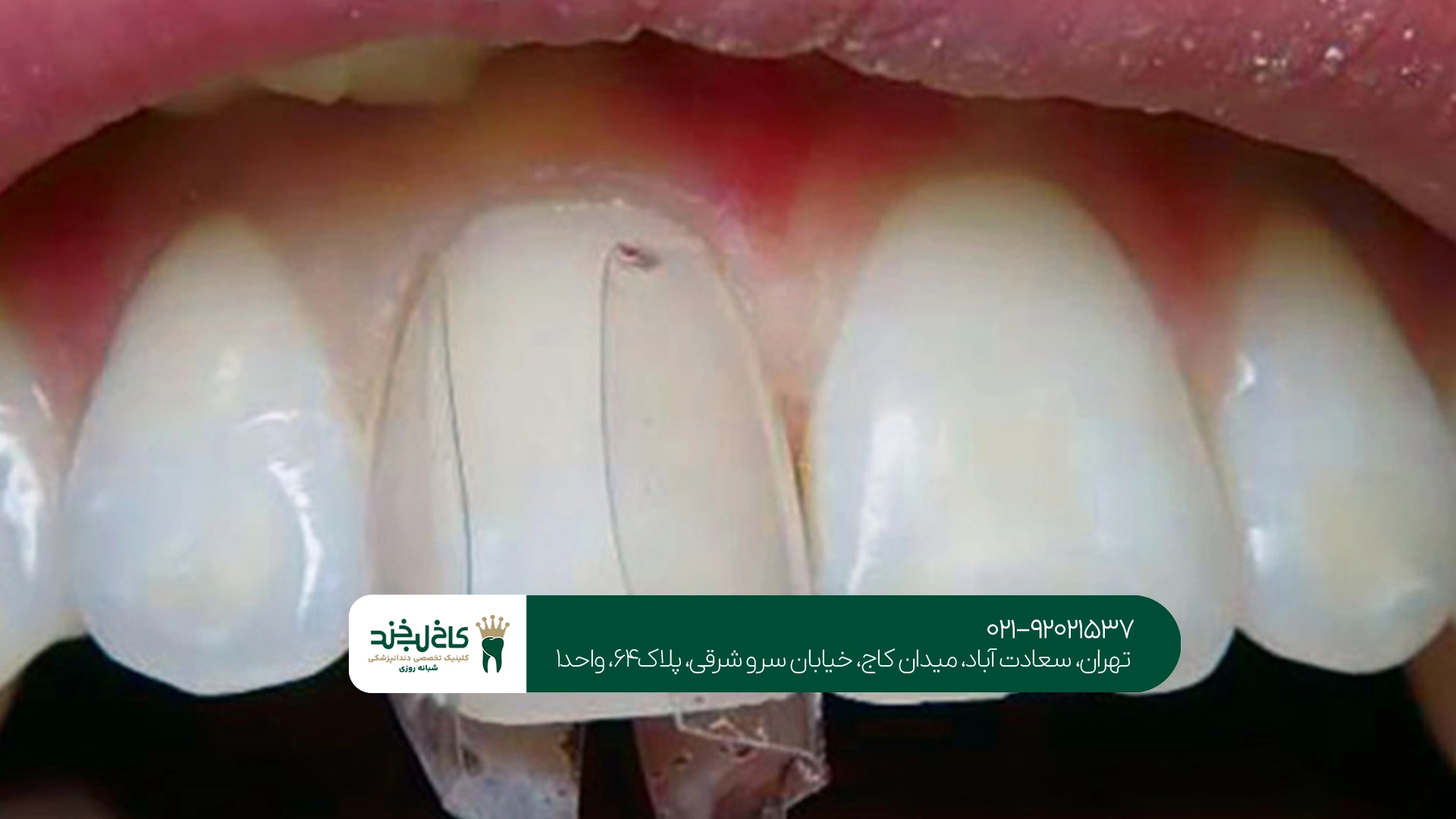 مراقبت بعد از ترمیم دندان شکسته