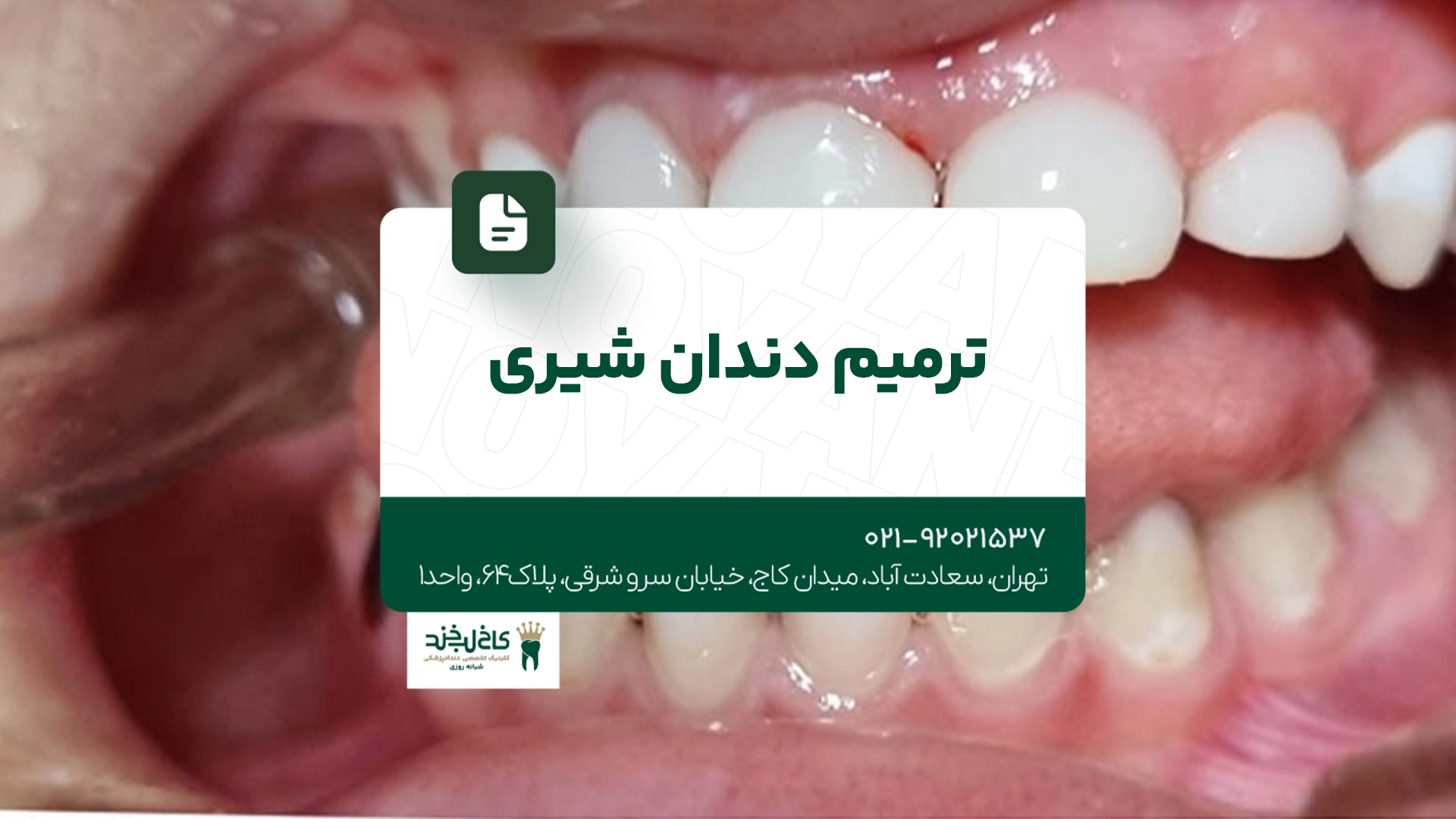 ترمیم دندان شیری ترمیم دندان شیری