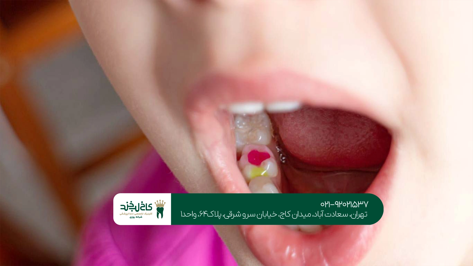 پوسیدگی دندان شیری پوسیدگی دندان شیری