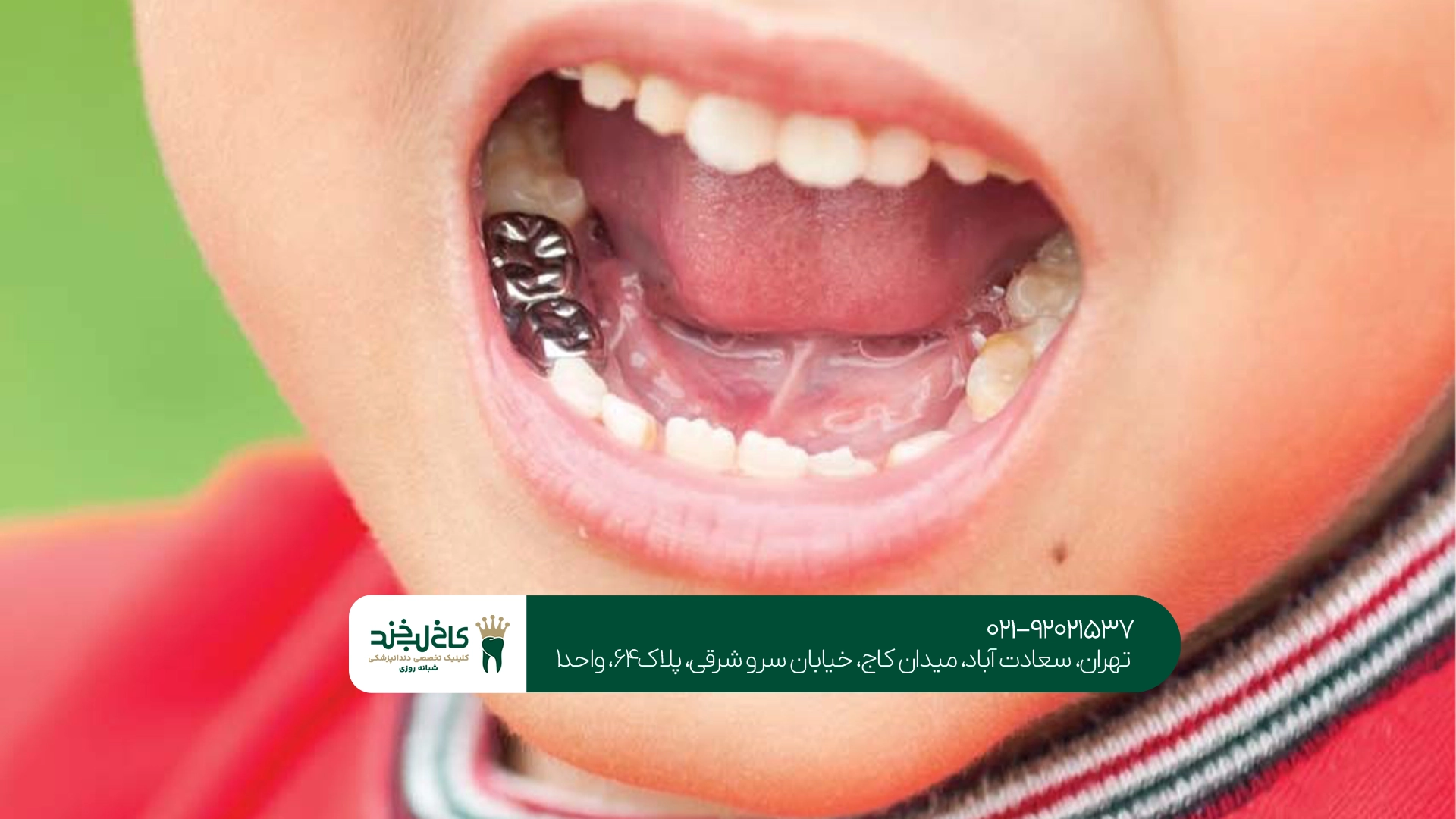مراقبتهای بعد از ترمیم دندان شیری کودک مراقبتهای بعد از ترمیم دندان شیری کودک