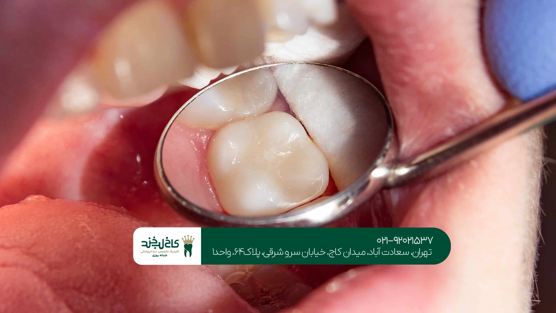 ترمیم دندان در یک جلسه امکانپذیر است؟