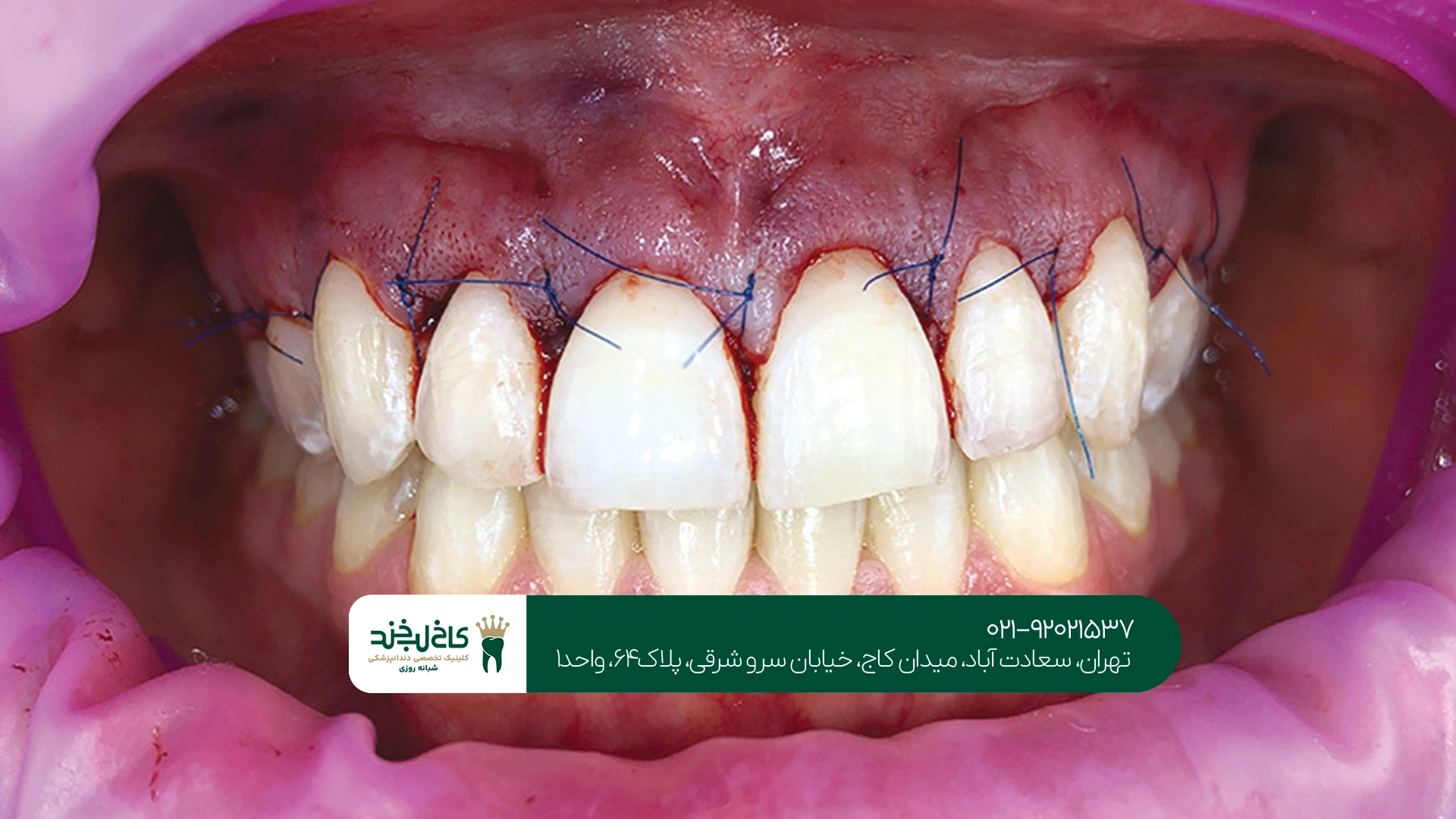 هزینه جراحی لثه به چه عواملی بستگی دارد؟
