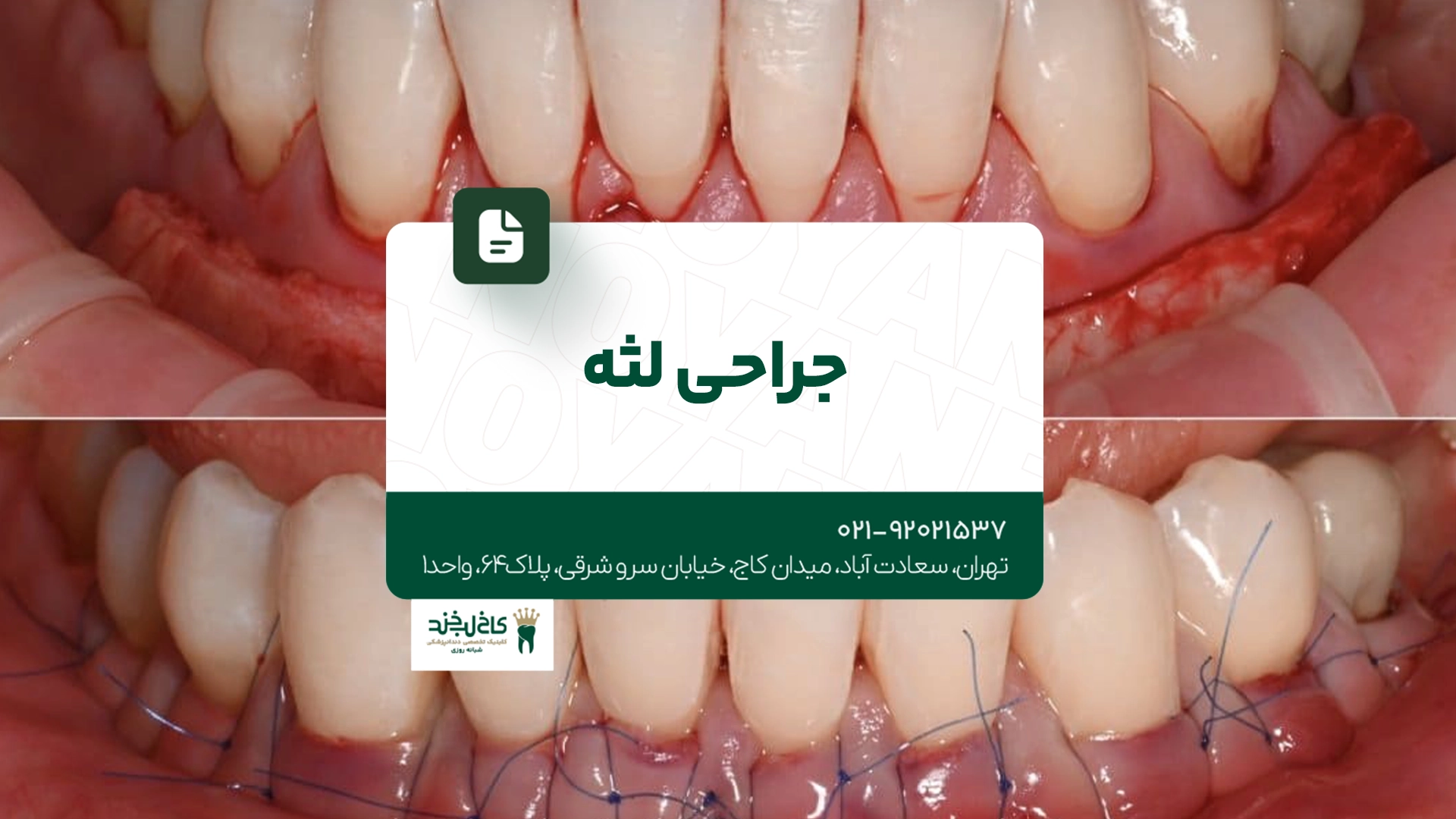 جراحی لثه