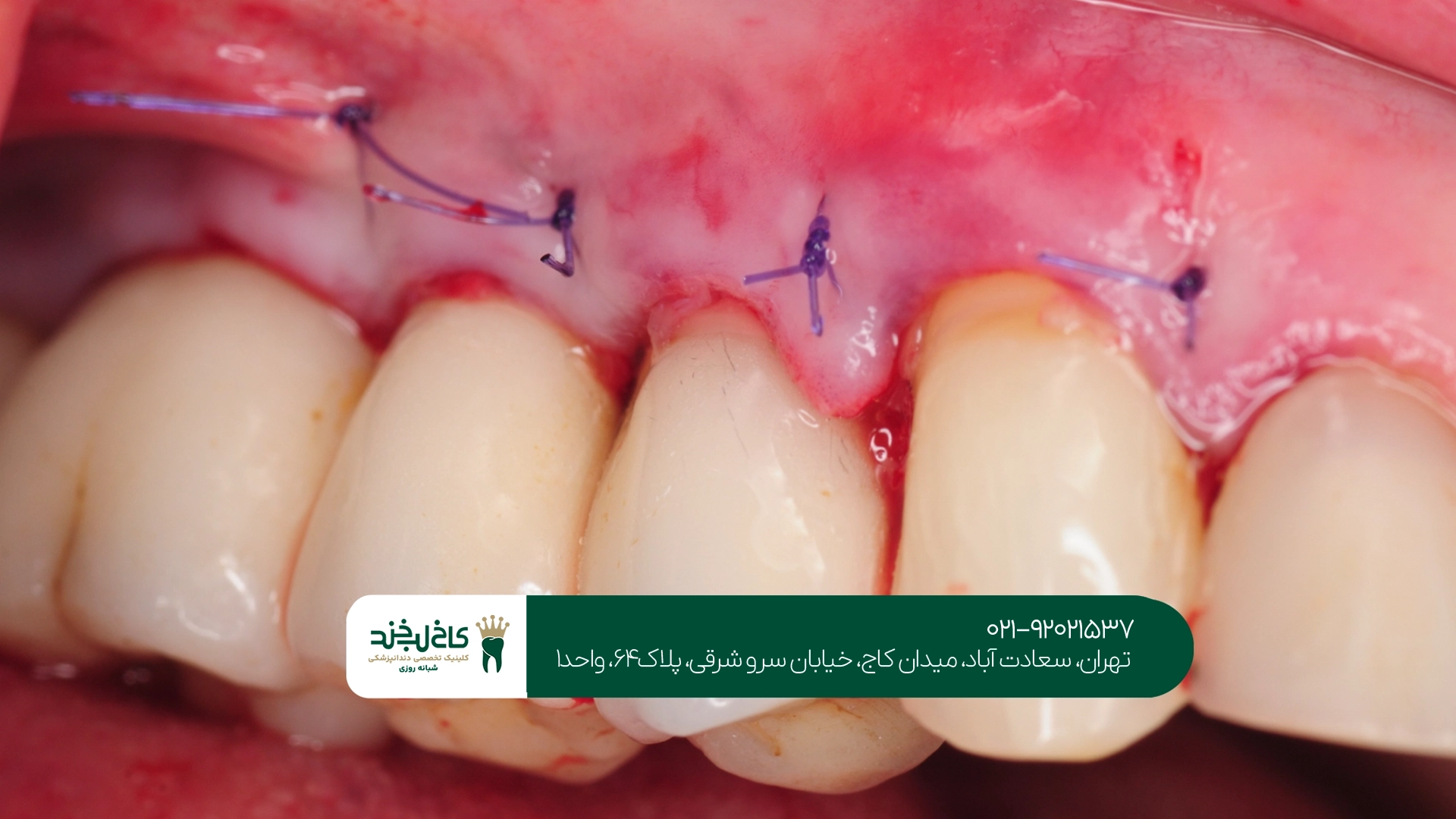 مراقبتهای بعد از جراحی لثه