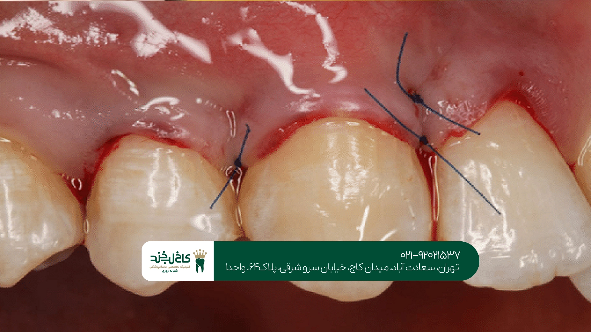 جراحی لثه برای درمان بیماریهای لثه
