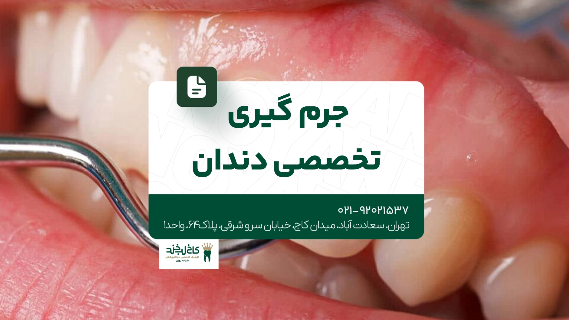 جرم گیری تخصصی دندان