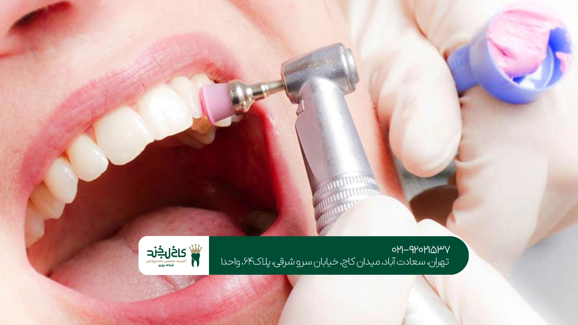 جرم گیری دندان در تهران