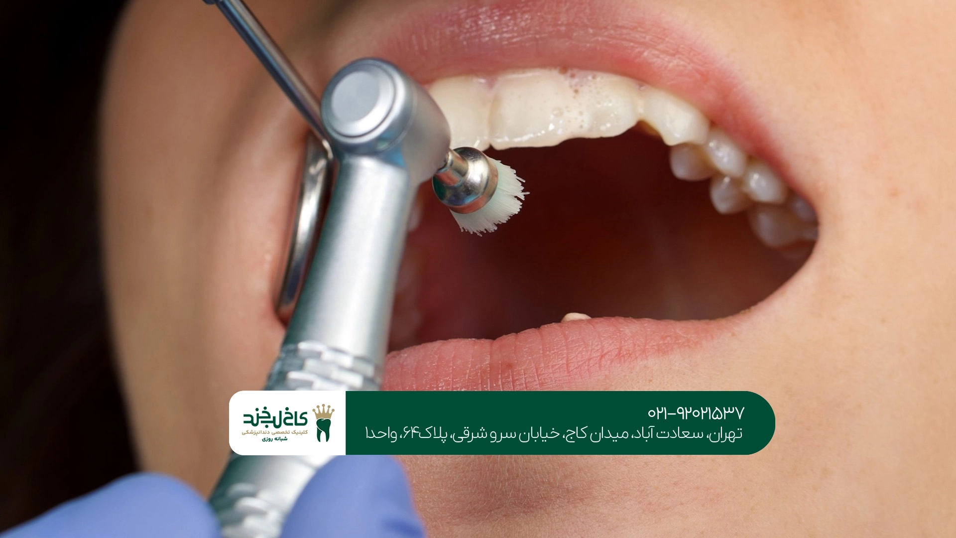 مراقبتهای بعد از جرم گیری تخصصی دندان