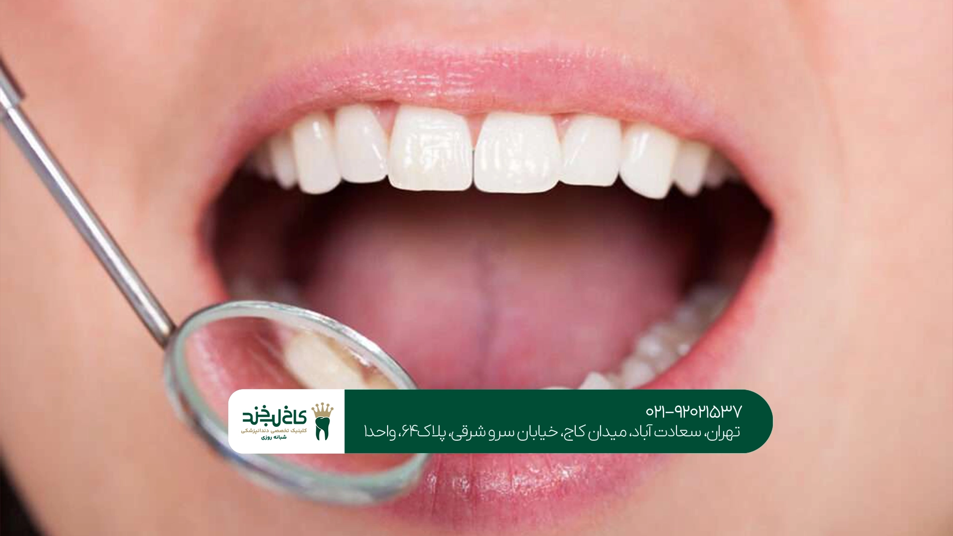 هزینه جرم گیری دندان به چه عواملی بستگی دارد؟