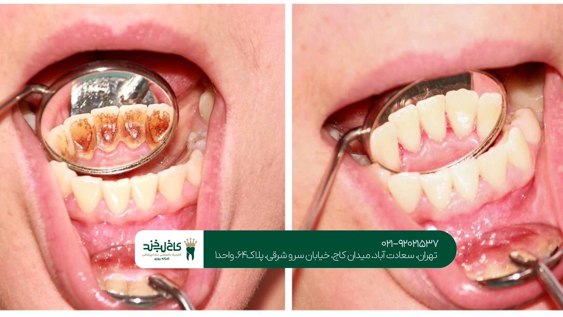 جرم گیری دندان هر چند وقت یک بار انجام شود؟