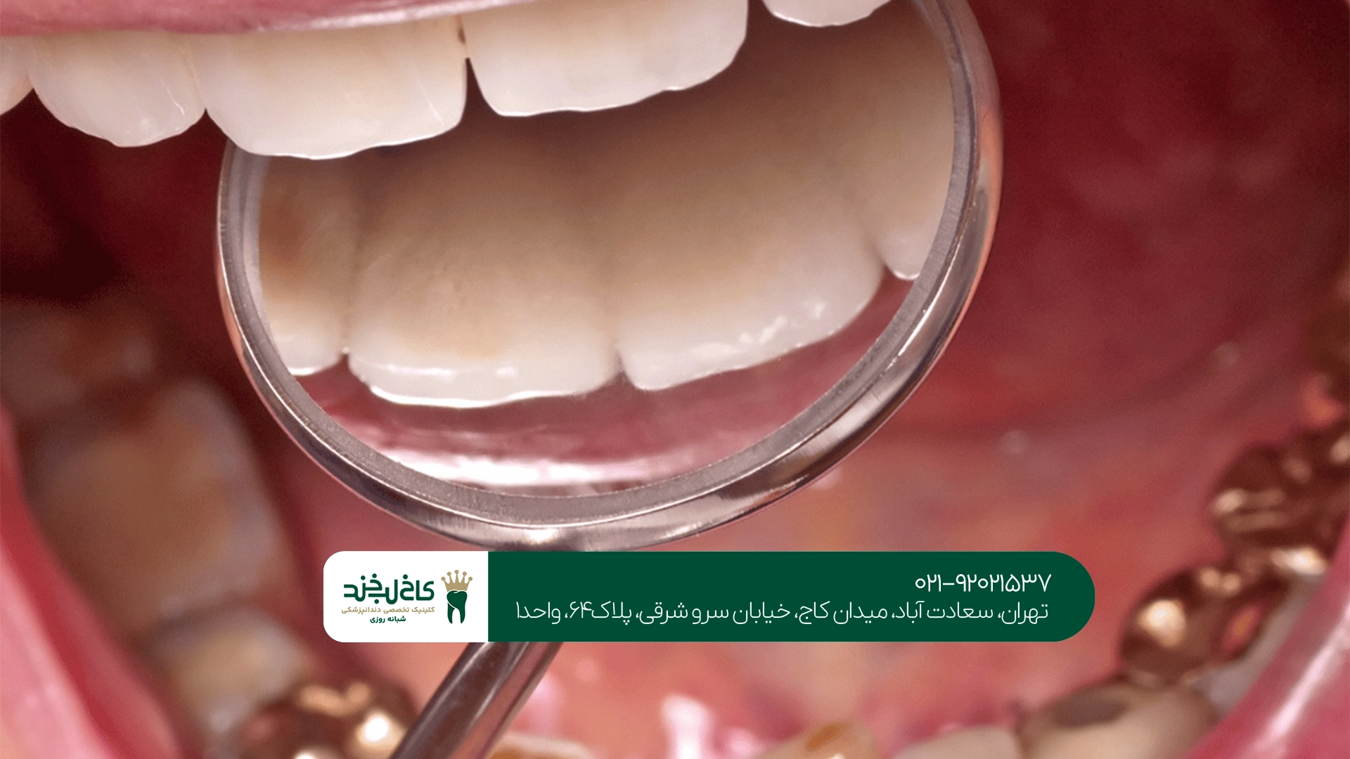 آیا جرم گیری دندان درد دارد؟