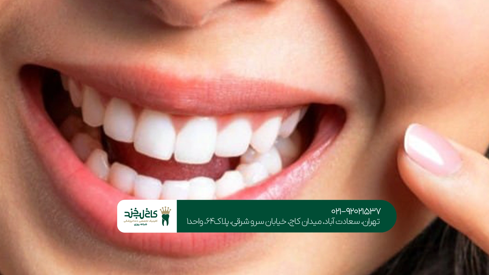 لمینت دندان و تغییر ظاهر لبخند