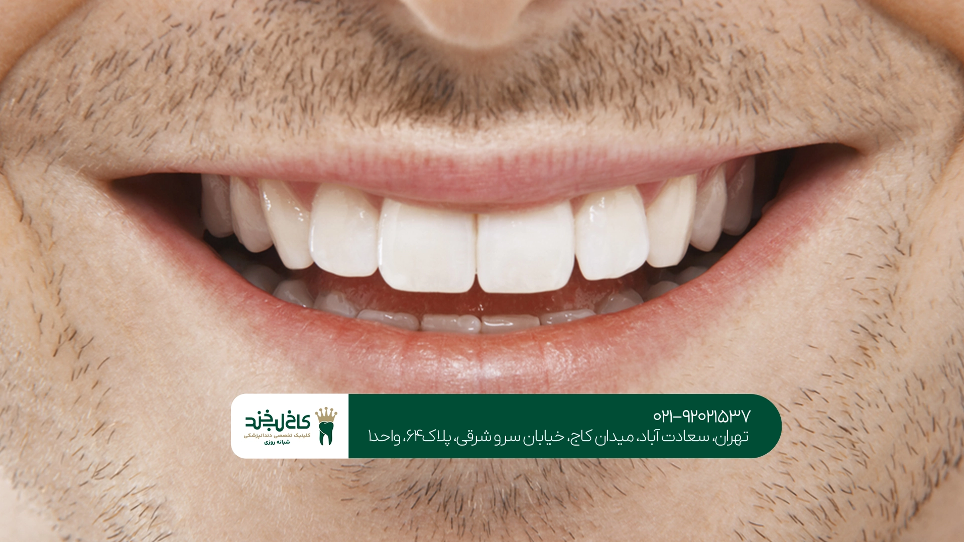 طراحی لبخند دیجیتال چگونه انجام میشود؟