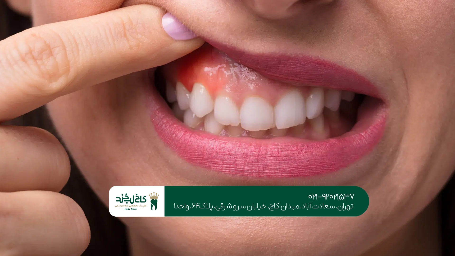 درمان حساسیت دندان به سرما