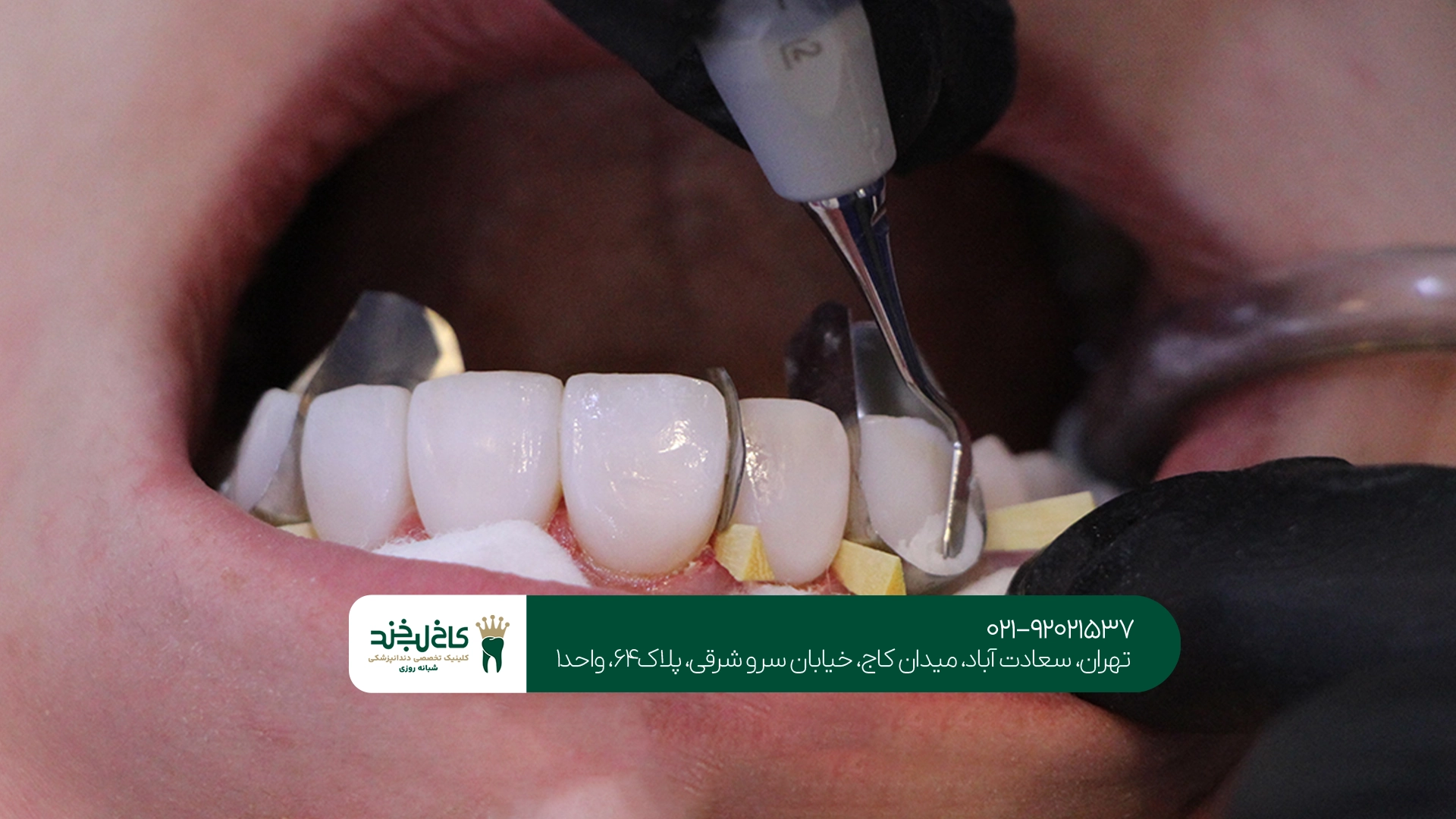 خدمات زیبایی دندان نزد دندانپزشک سعادت آباد