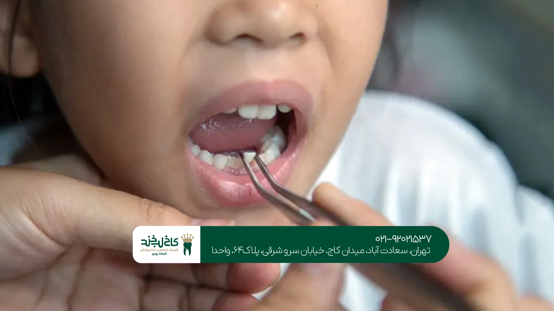 پوسیدگی دندان کودکان پوسیدگی دندان کودکان