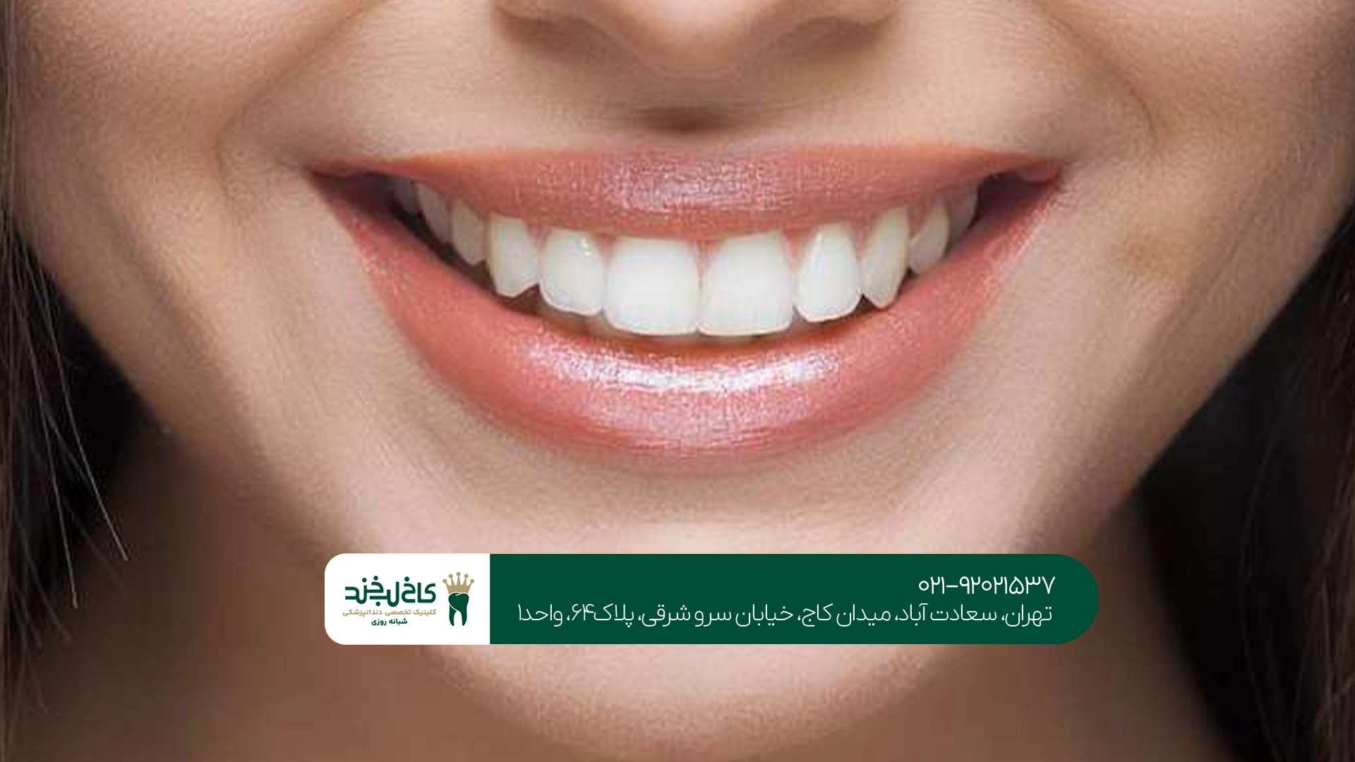 بلیچینگ و سفید کردن دندانها