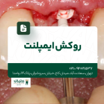 روکش ایمپلنت