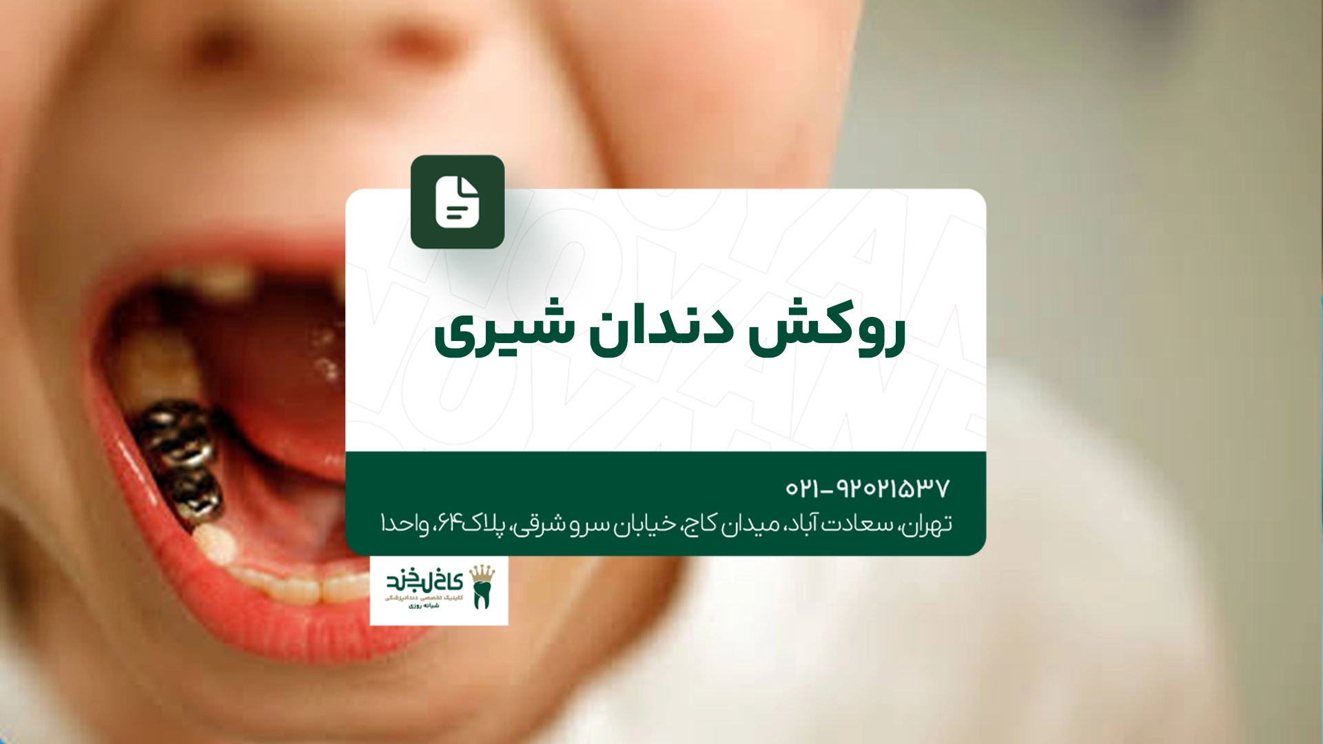 روکش دندان شیری