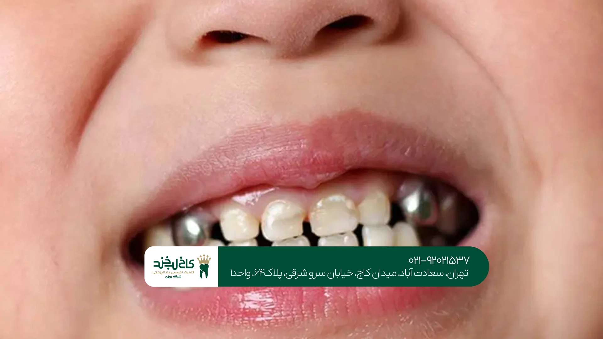 روکش دندان شیری چگونه انجام میشود؟