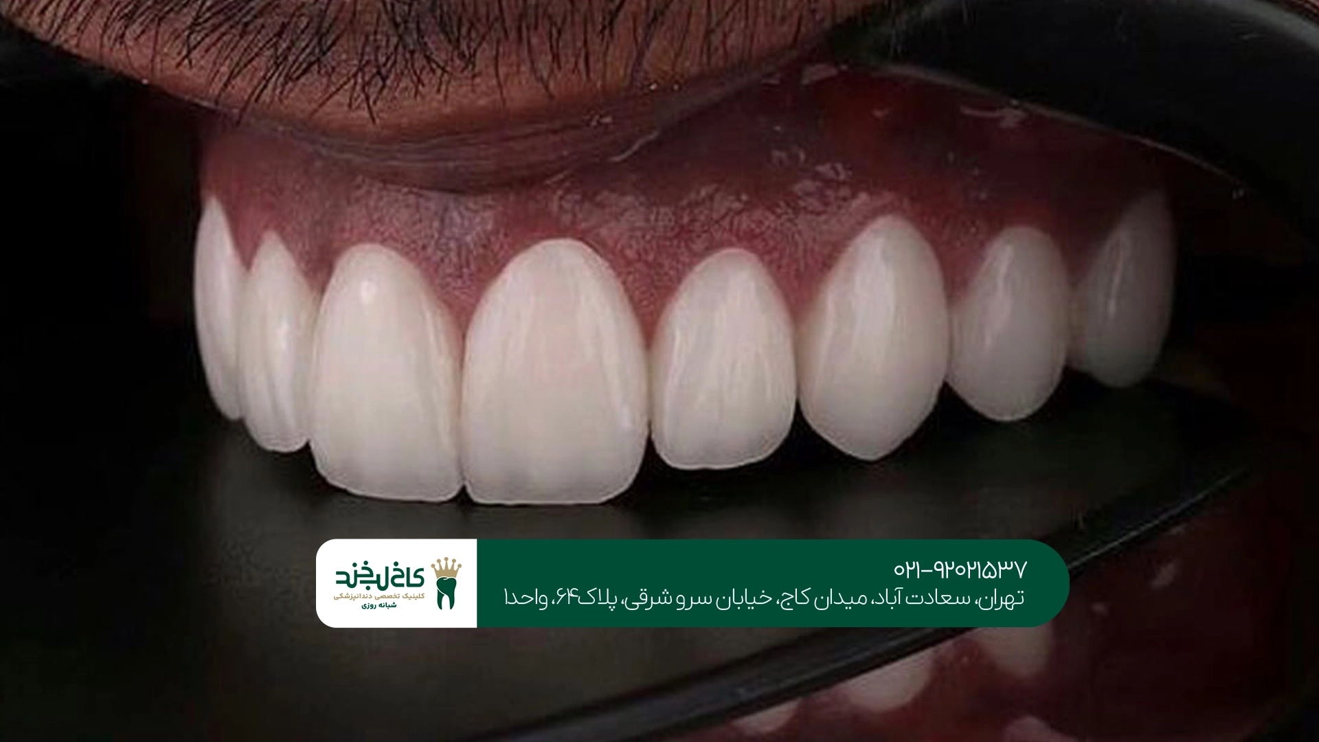 آیا روکش دندان باعث درد یا حساسیت میشود؟