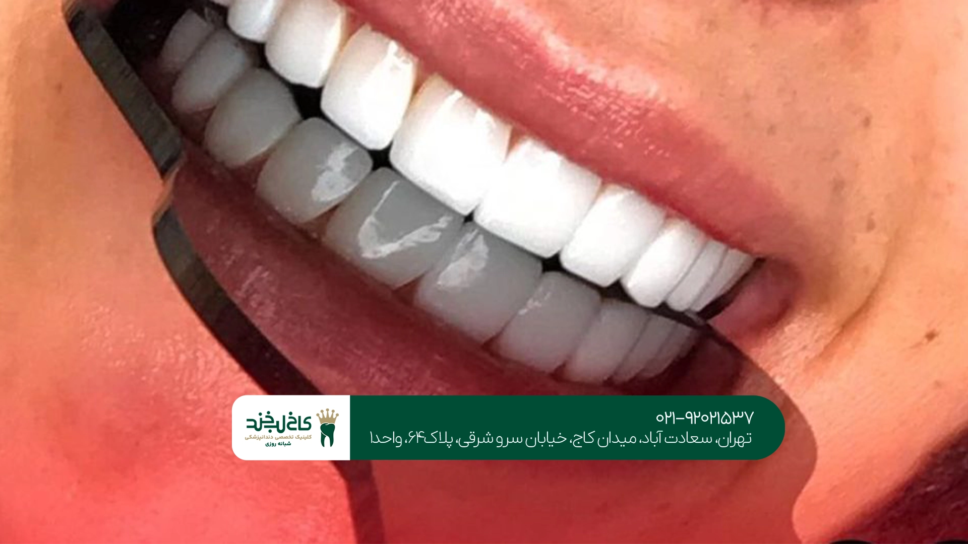 چه زمانی باید روکش دندان تعویض شود؟