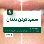سفید کردن دندان