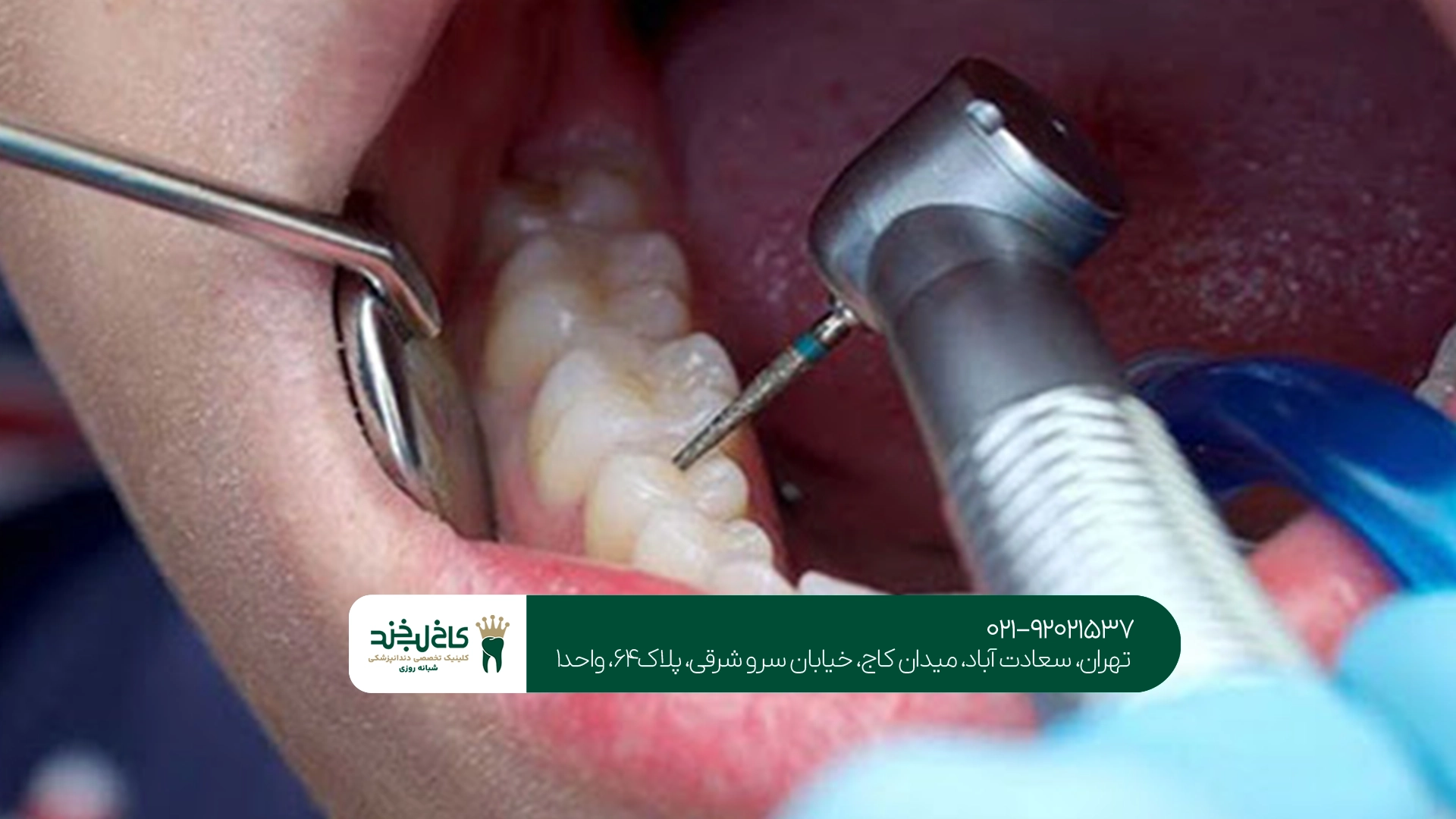 بهترین دندانپزشک کودکان برای عصب کشی بهترین دندانپزشک کودکان برای عصب کشی