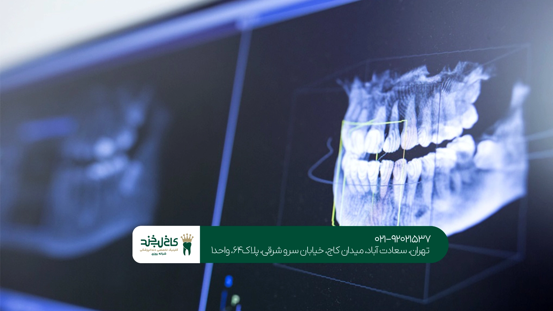 عکس OPG دندان برای تشخیص پوسیدگی و مشکلات ریشه