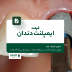 قیمت ایمپلنت دندان
