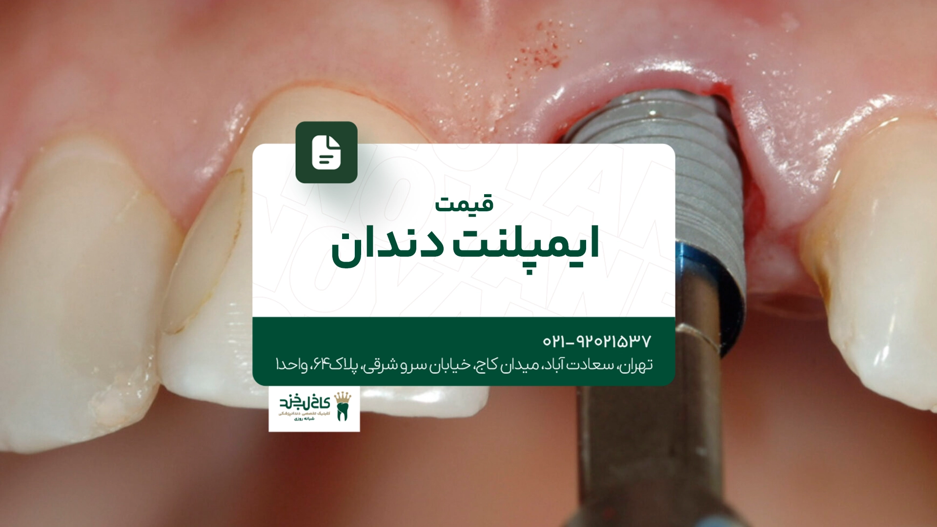 قیمت ایمپلنت دندان