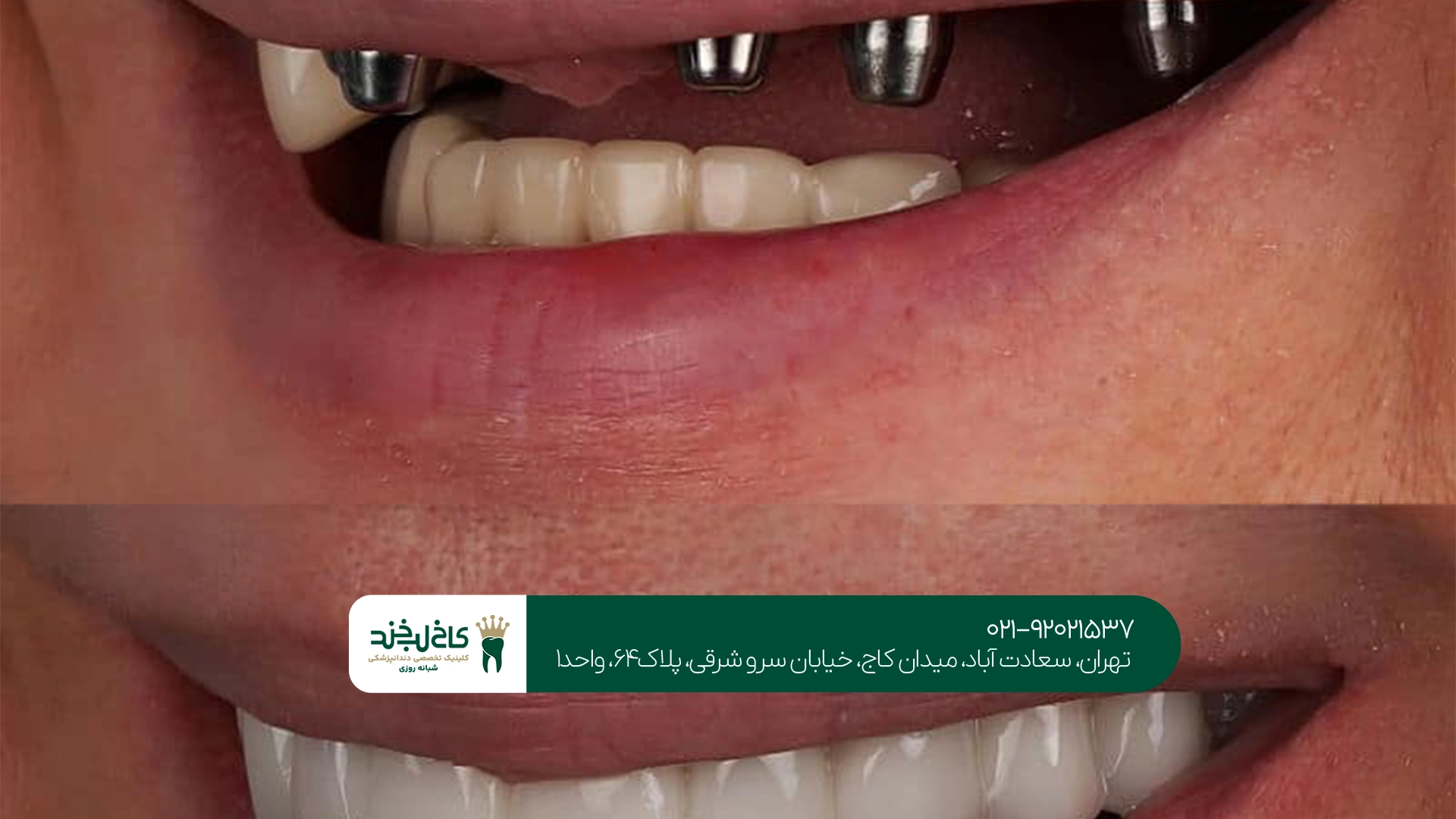 قیمت ایمپلنت دندان چگونه محاسبه میشود؟