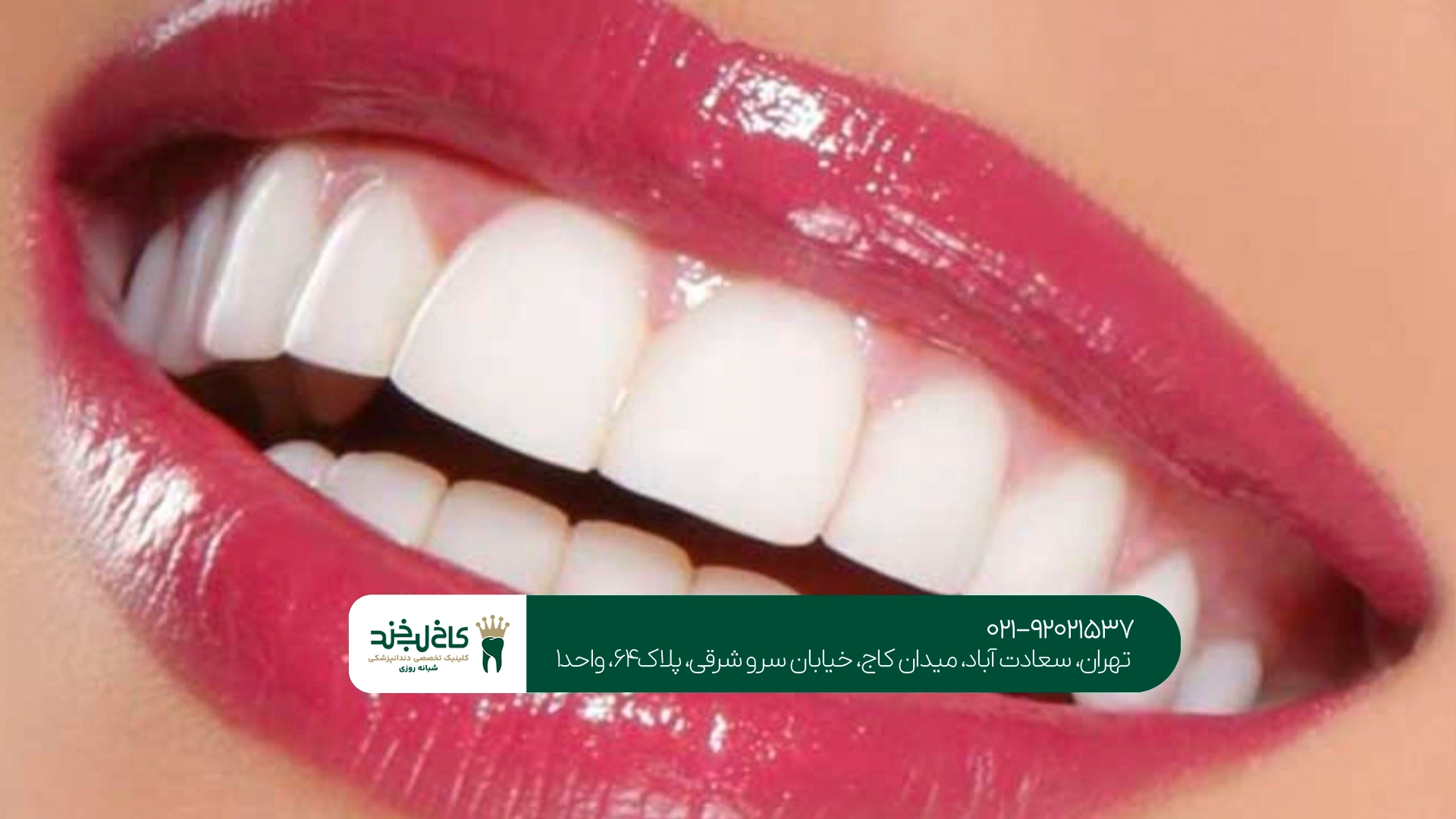 روکش دندان