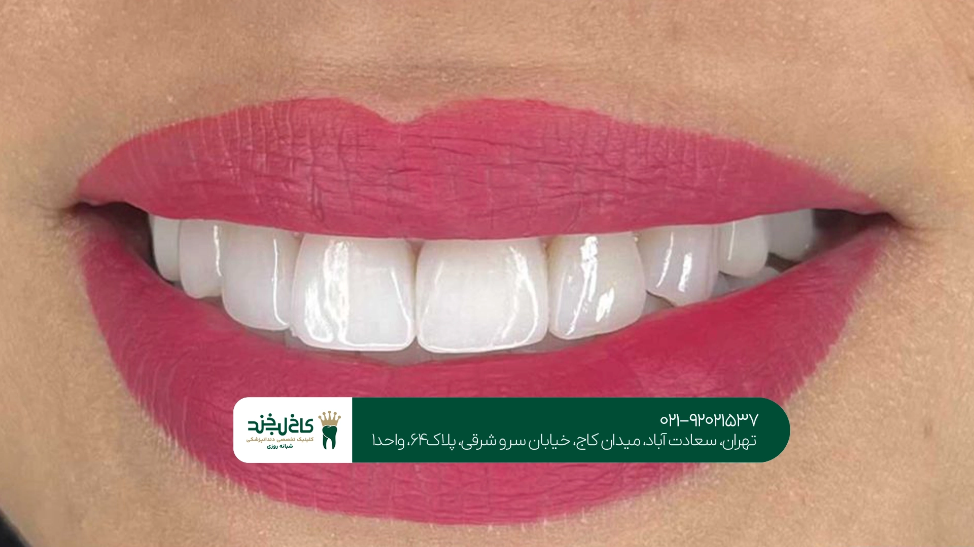 کامپوزیت و لمینت برای اصلاح ظاهر دندانها