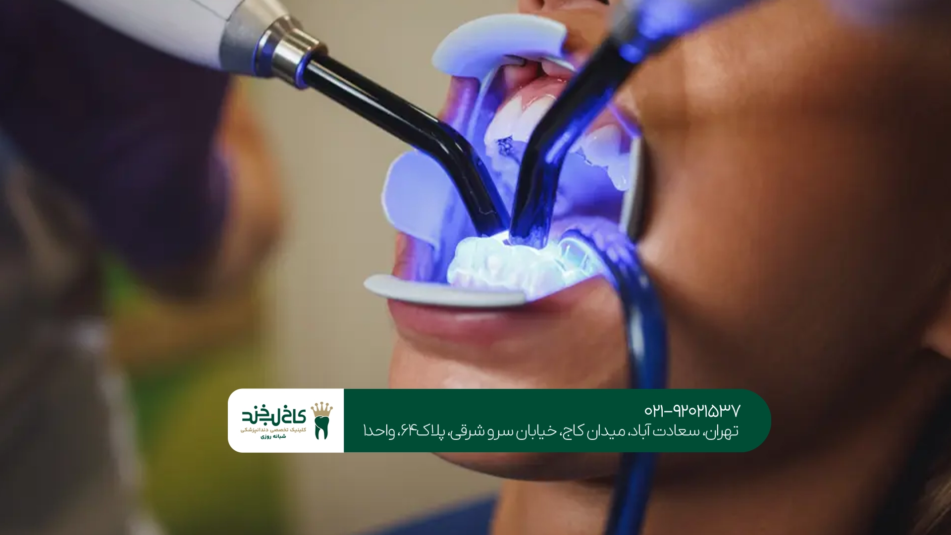 انتخاب بهترین روش کامپوزیت