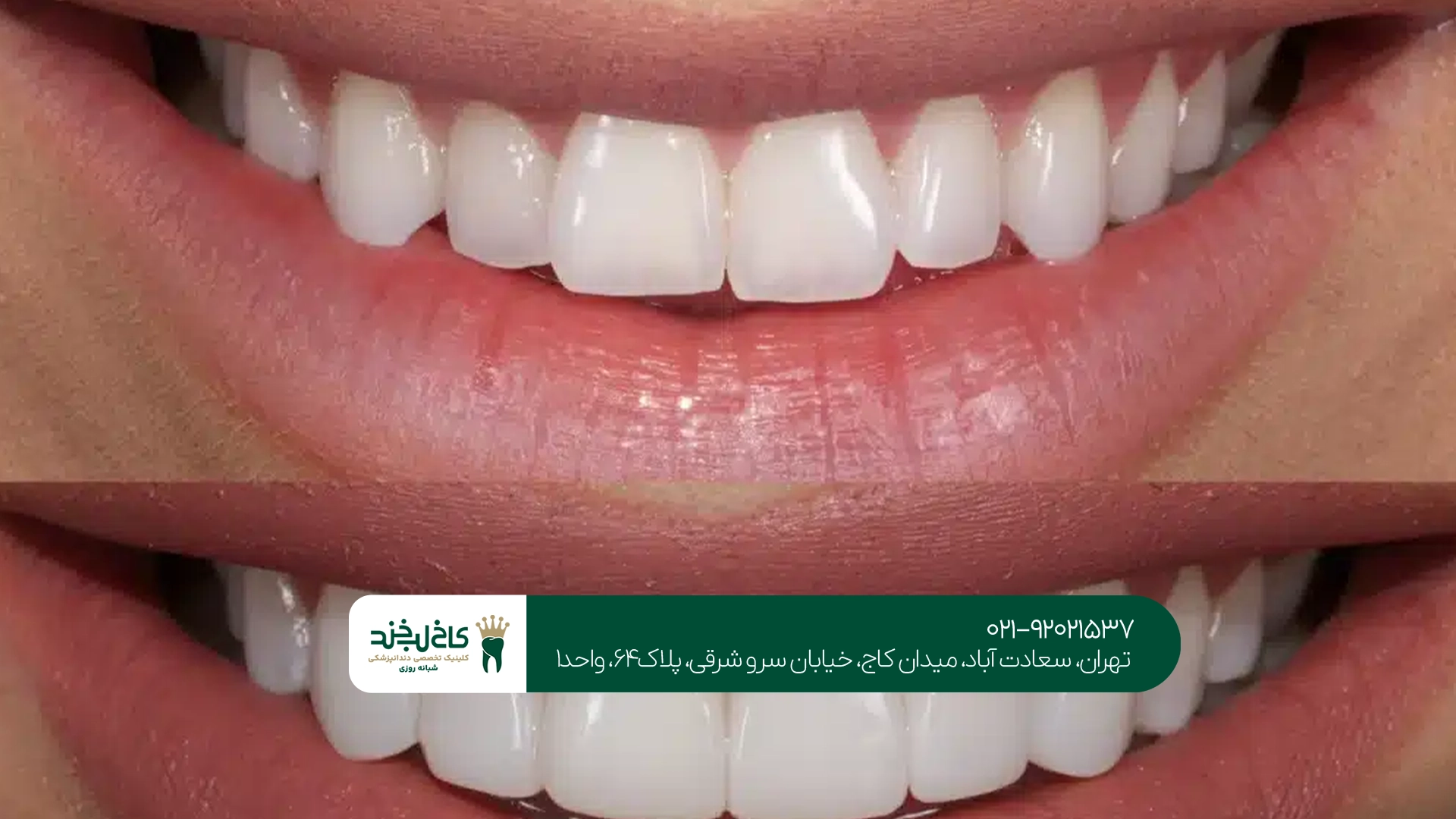 کامپوزیت دندان برای چه افرادی مناسب است؟