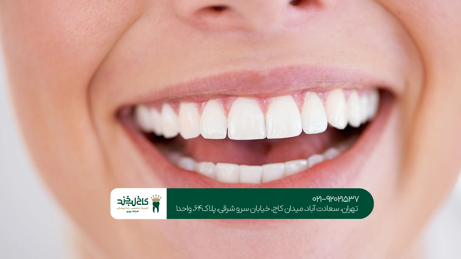 کامپوزیت دندان بدون تراش