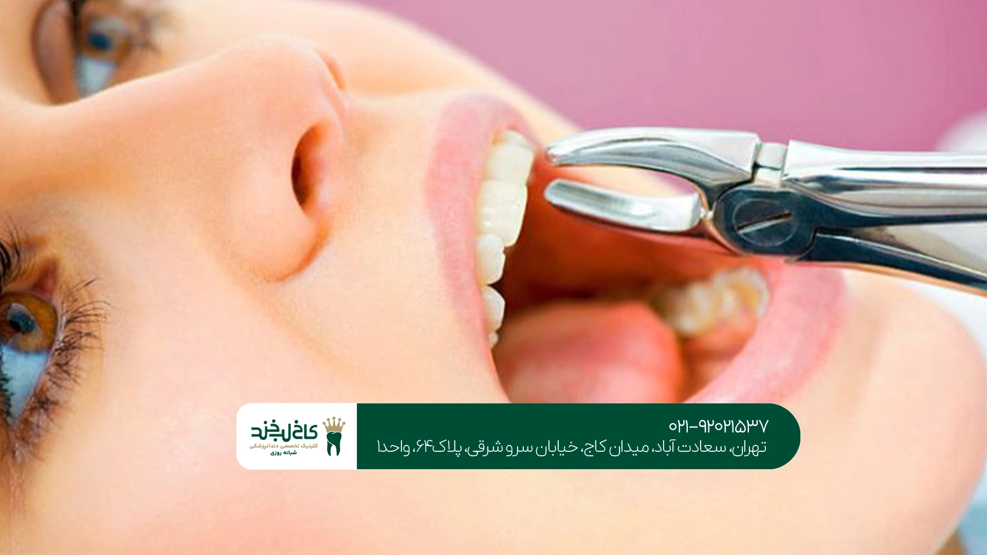 کشیدن دندان عقل چه تفاوتی با دندان معمولی دارد؟