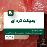 ایمپلنت کره ای