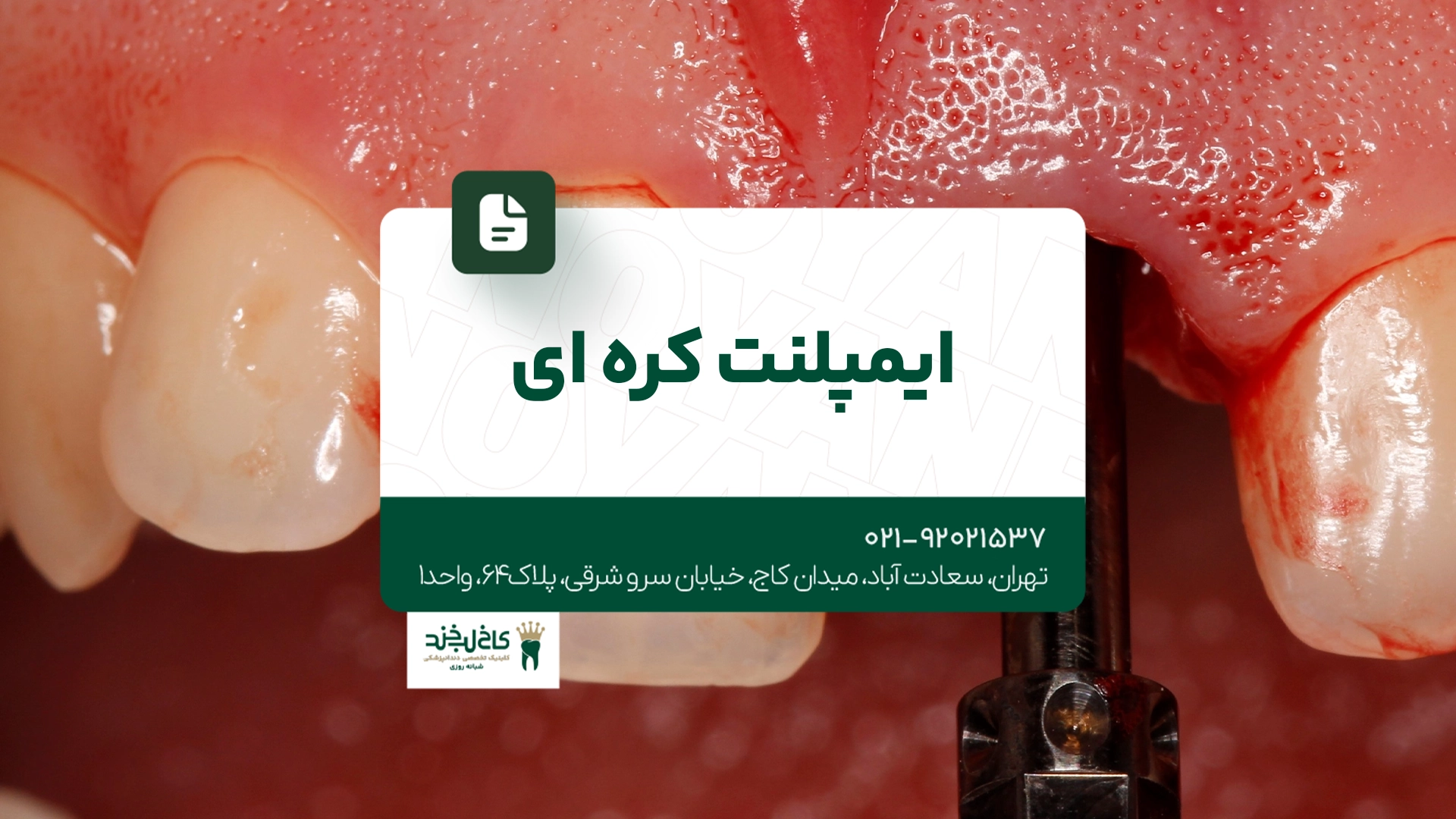 ایمپلنت کره ای