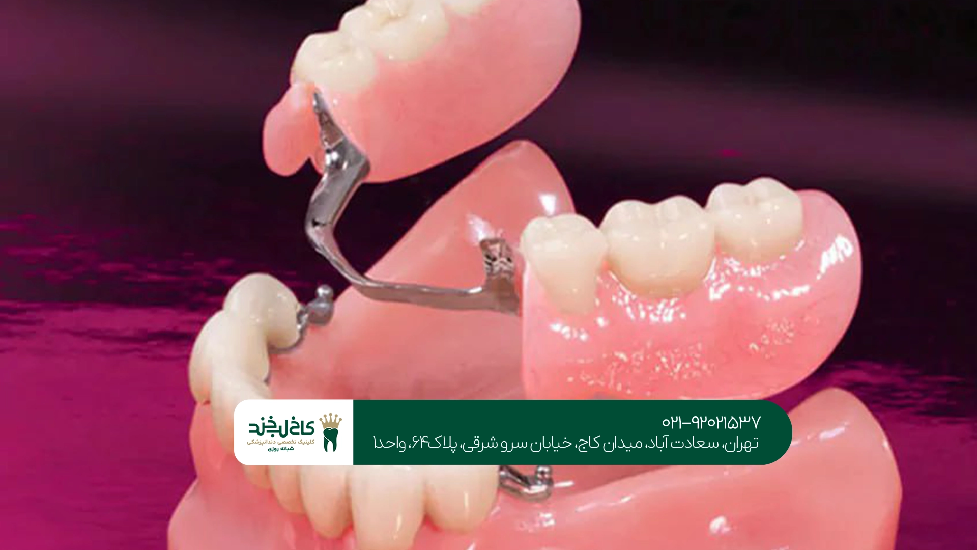 قیمت دندان مصنوعی بر پایه ایمپلنت
